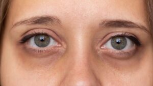 Best Natural Remedies to Reduce Dark Circles Without Chemicals: Know Here!