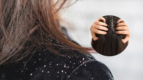 Why Dandruff Gets Worse in Winter and How Smart Scalp Care Can Prevent It