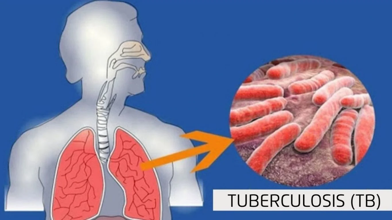 Delhi-Bihar TB Cases: Over 99,000 Cases Detected in Screening